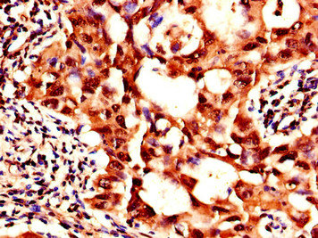 SIK1 / MSK Antibody - Immunohistochemistry of paraffin-embedded human lung cancer using SIK1 Antibody at dilution of 1:100