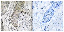 SIK3 / QSK Antibody - Immunohistochemistry analysis of paraffin-embedded human lung carcinoma tissue, using QSK Antibody. The picture on the right is blocked with the synthesized peptide.