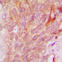 SIK3 / QSK Antibody - Immunohistochemical analysis of QSK staining in human breast cancer formalin fixed paraffin embedded tissue section. The section was pre-treated using heat mediated antigen retrieval with sodium citrate buffer (pH 6.0). The section was then incubated with the antibody at room temperature and detected with HRP and DAB as chromogen. The section was then counterstained with hematoxylin and mounted with DPX.