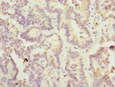 SIK3 / QSK Antibody - Immunohistochemistry of paraffin-embedded human lung cancer at dilution 1:100