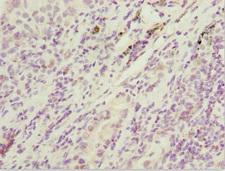 SIK3 / QSK Antibody - Immunohistochemistry of paraffin-embedded human lung cancer at dilution 1:100