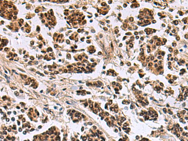 SIK3 / QSK Antibody - Immunohistochemistry of paraffin-embedded Human breast cancer tissue  using SIK3 Polyclonal Antibody at dilution of 1:60(×200)