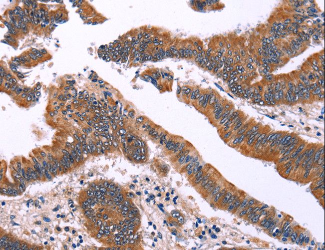 SIMPL / IRAK1BP1 Antibody - Immunohistochemistry of paraffin-embedded Human colon cancer using IRAK1BP1 Polyclonal Antibody at dilution of 1:40.