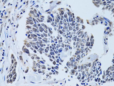 SIN3A Antibody - Immunohistochemistry of paraffin-embedded human lung cancer using SIN3A antibody at dilution of 1:100 (40x lens).