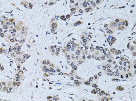 SIN3A Antibody - Immunohistochemistry of paraffin-embedded human liver cancer using SIN3A antibody at dilution of 1:100 (40x lens).