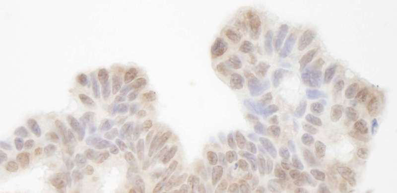 SIN3A Antibody - Detection of Human Sin3A by Immunohistochemistry. Sample: FFPE section of human ovarian tumor. Antibody: Affinity purified rabbit anti-Sin3A used at a dilution of 1:250.