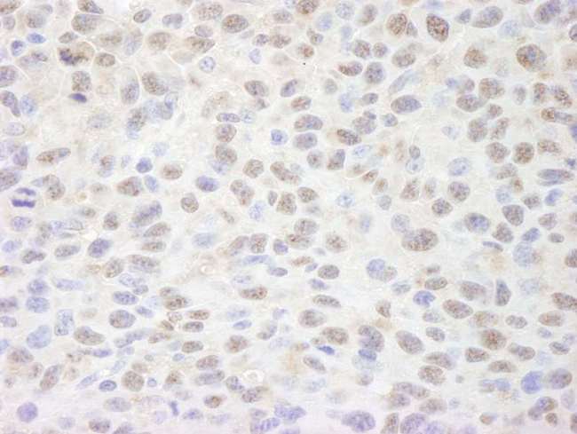 SIN3A Antibody - Detection of Mouse Sin3A by Immunohistochemistry. Sample: FFPE section of mouse squamous cell carcinoma. Antibody: Affinity purified rabbit anti-Sin3A used at a dilution of 1:250.