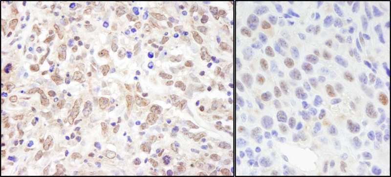 SIN3A Antibody - Detection of Human and Mouse Sin3A by Immunohistochemistry. Sample: FFPE sections of human metastatic lymph node (left) and mouse squamous cell carcinoma (right). Antibody: Affinity purified rabbit anti-Sin3A used at a dilution of 1:200 (1 ug/ml). Detection: DAB.