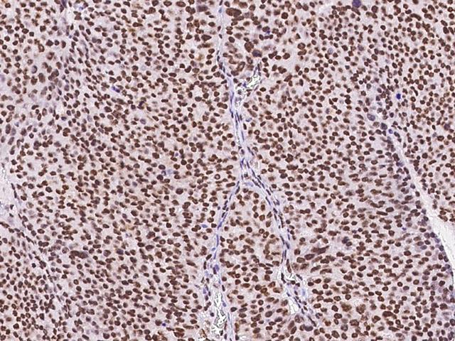 SIN3A Antibody - Immunochemical staining of human SIN3A in human ovarian cancer with rabbit polyclonal antibody at 1:300 dilution, formalin-fixed paraffin embedded sections.