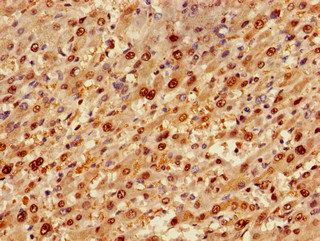 SIP / TP53INP1 Antibody - Immunohistochemistry of paraffin-embedded human liver cancer using TP53INP1 Antibody at dilution of 1:100