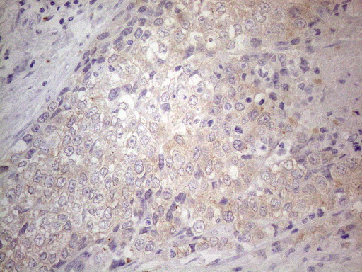SIP1 Antibody - Immunohistochemical staining of paraffin-embedded Adenocarcinoma of Human endometrium tissue using anti-GEMIN2 mouse monoclonal antibody. (Heat-induced epitope retrieval by 1mM EDTA in 10mM Tris buffer. (pH8.5) at 120°C for 3 min. (1:150)