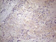 SIP1 Antibody - Immunohistochemical staining of paraffin-embedded Adenocarcinoma of Human endometrium tissue using anti-GEMIN2 mouse monoclonal antibody. (Heat-induced epitope retrieval by 1mM EDTA in 10mM Tris buffer. (pH8.5) at 120°C for 3 min. (1:150)