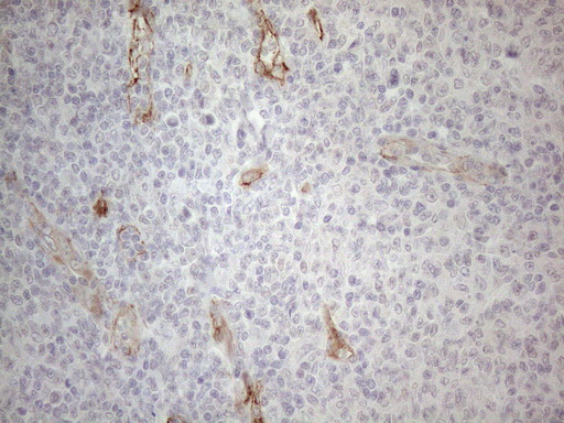 SIP1 Antibody - Immunohistochemical staining of paraffin-embedded Human lymphoma tissue using anti-GEMIN2 mouse monoclonal antibody. (Heat-induced epitope retrieval by 1mM EDTA in 10mM Tris buffer. (pH8.5) at 120°C for 3 min. (1:150)