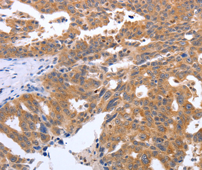 SIP1 Antibody - Immunohistochemistry of paraffin-embedded human ovarian cancer tissue using GEMIN2 antibody.