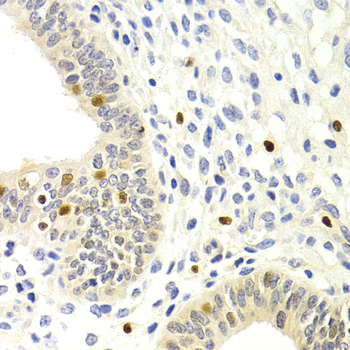 SIP1 Antibody - Immunohistochemistry of paraffin-embedded human metrocarcinoma tissue.