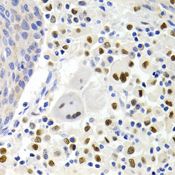 SIP1 Antibody - Immunohistochemistry of paraffin-embedded human lung cancer tissue.