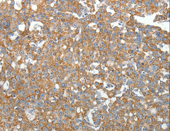 SIP1 Antibody - Immunohistochemistry of paraffin-embedded Human gastric cancer using GEMIN2 Polyclonal Antibody at dilution of 1:40.