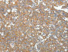 SIP1 Antibody - Immunohistochemistry of paraffin-embedded Human gastric cancer using GEMIN2 Polyclonal Antibody at dilution of 1:40.