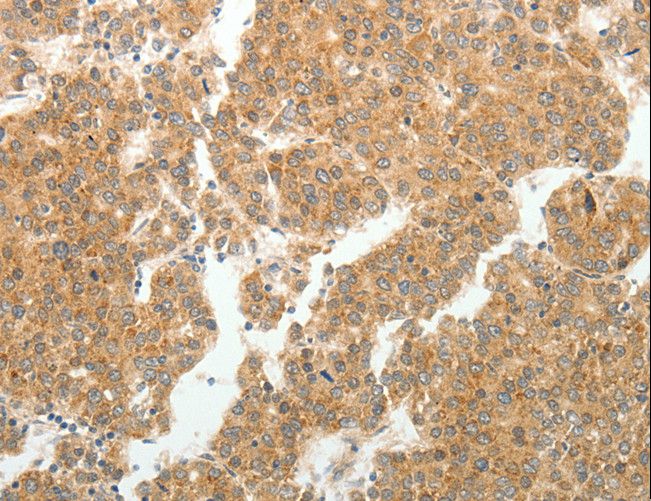 SIP1 Antibody - Immunohistochemistry of paraffin-embedded Human ovarian cancer using GEMIN2 Polyclonal Antibody at dilution of 1:40.