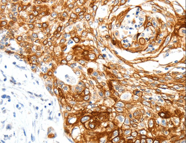 SIPA1 Antibody - Immunohistochemistry of paraffin-embedded Human cervical cancer using SIPA1 Polyclonal Antibody at dilution of 1:40.