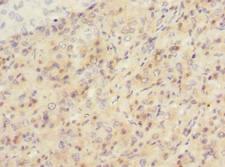 SIPA1L2 Antibody - Immunohistochemistry of paraffin-embedded human liver cancer using antibody at dilution of 1:100.