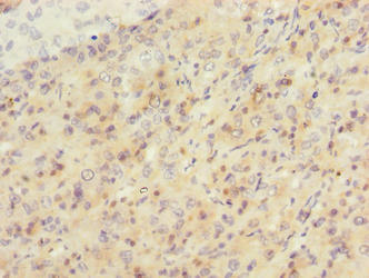 SIPA1L2 Antibody - Immunohistochemistry of paraffin-embedded human liver cancer using SIPA1L2 Antibody at dilution of 1:100