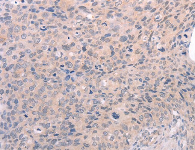 SIPR3 / EDG3 / S1P3 Antibody - Immunohistochemistry of paraffin-embedded Human cervical cancer using S1PR3 Polyclonal Antibody at dilution of 1:30.