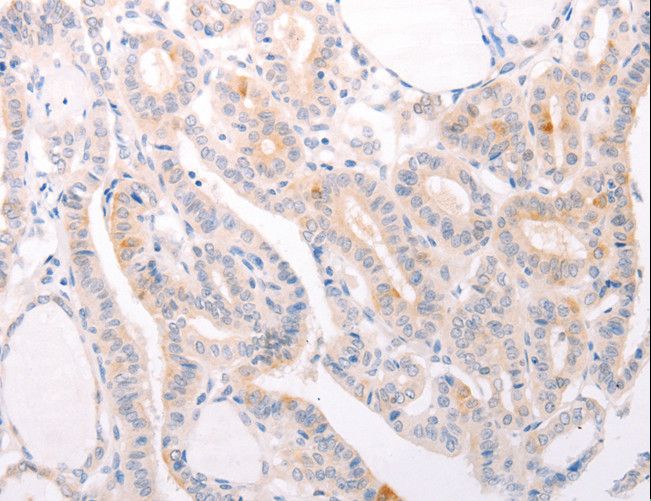 SIPR3 / EDG3 / S1P3 Antibody - Immunohistochemistry of paraffin-embedded Human thyroid cancer using S1PR3 Polyclonal Antibody at dilution of 1:30.