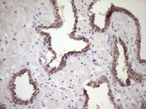 SIRPA / CD172a Antibody - Immunohistochemical staining of paraffin-embedded Carcinoma of Human prostate tissue using anti-SIRPA mouse monoclonal antibody. (Heat-induced epitope retrieval by Tris-EDTA, pH8.0)(1:150)