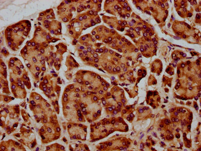 SIRPA / CD172a Antibody - Immunohistochemistry Dilution at 1:400 and staining in paraffin-embedded human pancreatic cancer performed on a Leica BondTM system. After dewaxing and hydration, antigen retrieval was mediated by high pressure in a citrate buffer (pH 6.0). Section was blocked with 10% normal Goat serum 30min at RT. Then primary antibody (1% BSA) was incubated at 4°C overnight. The primary is detected by a biotinylated Secondary antibody and visualized using an HRP conjugated SP system.