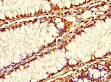 SIRPB1 / CD172b Antibody - Immunohistochemistry of paraffin-embedded human colon cancer at dilution 1:100