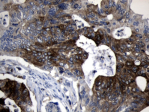 SIRT1 / Sirtuin 1 Antibody - Immunohistochemical staining of paraffin-embedded Adenocarcinoma of Human colon tissue using anti-SIRT1 mouse monoclonal antibody. (Heat-induced epitope retrieval by 1mM EDTA in 10mM Tris buffer. (pH8.5) at 120°C for 3 min. (1:2000)