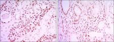 SIRT1 / Sirtuin 1 Antibody - Immunohistochemistry-Paraffin: SIRT1 Antibody (1F3) - Immunohistochemical analysis of paraffin-embedded lung cancer tissues (left) and kidney cancer tissues (right) using SIRT1 mouse mAb with DAB staining.