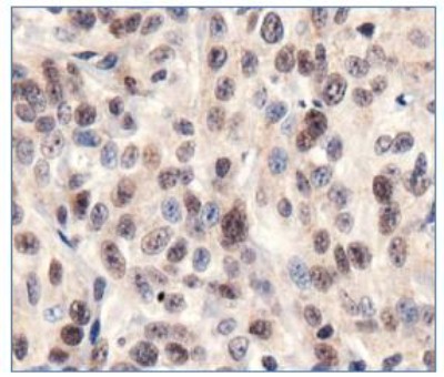 SIRT1 / Sirtuin 1 Antibody - Immunohistochemistry: SIRT1 Antibody - IHC of SIRT1 in human renal cell carcinoma.  This image was taken for the unconjugated form of this product. Other forms have not been tested.