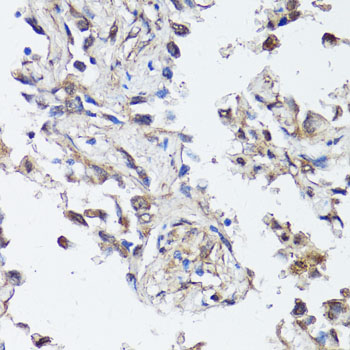 SIRT1 / Sirtuin 1 Antibody - Immunohistochemistry of paraffin-embedded human lung cancer using SIRT1 antibodyat dilution of 1:100 (40x lens).