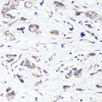 SIRT1 / Sirtuin 1 Antibody - Immunohistochemistry of paraffin-embedded human gastric cancer using SIRT1 antibodyat dilution of 1:100 (40x lens).