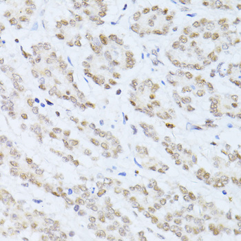SIRT1 / Sirtuin 1 Antibody - Immunohistochemistry of paraffin-embedded human colon carcinoma using SIRT1 antibody at dilution of 1:100 (40x lens).