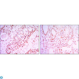 SIRT1 / Sirtuin 1 Antibody - Immunohistochemistry (IHC) analysis of paraffin-embedded Lung Cancer Tissues (left) and kidney cancer tissues (right) with DAB staining using SIRT1 Monoclonal Antibody.