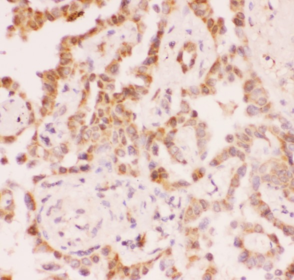 SIRT2 / Sirtuin 2 Antibody - SIRT2 antibody IHC-paraffin: Human Lung Cancer Tissue.