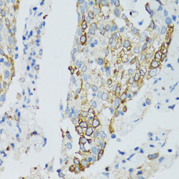 SIRT2 / Sirtuin 2 Antibody - Immunohistochemistry of paraffin-embedded human lung cancer using SIRT2 antibodyat dilution of 1:100 (40x lens).