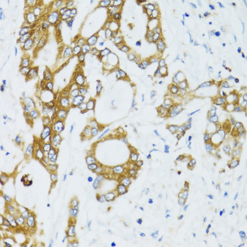 SIRT2 / Sirtuin 2 Antibody - Immunohistochemistry of paraffin-embedded human colon carcinoma using SIRT2 antibodyat dilution of 1:100 (40x lens).