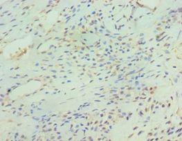 SIRT3 / Sirtuin 3 Antibody - Immunohistochemistry of paraffin-embedded human breast cancer using antibody at 1:100 dilution.
