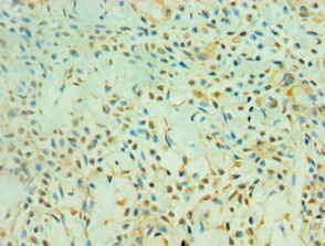 SIRT3 / Sirtuin 3 Antibody - Immunohistochemistry of paraffin-embedded breast cancer prostate using antibody at 1:100 dilution.