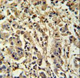 SIRT3 / Sirtuin 3 Antibody - Sirt3 Antibody IHC of formalin-fixed and paraffin-embedded human breast carcinoma followed by peroxidase-conjugated secondary antibody and DAB staining.