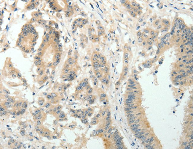 SIRT3 / Sirtuin 3 Antibody - Immunohistochemistry of paraffin-embedded Human colon cancer using SIRT3 Polyclonal Antibody at dilution of 1:30.
