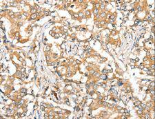 SIRT4 / Sirtuin 4 Antibody - Immunohistochemistry of paraffin-embedded Human lung cancer using SIRT4 Polyclonal Antibody at dilution of 1:35.