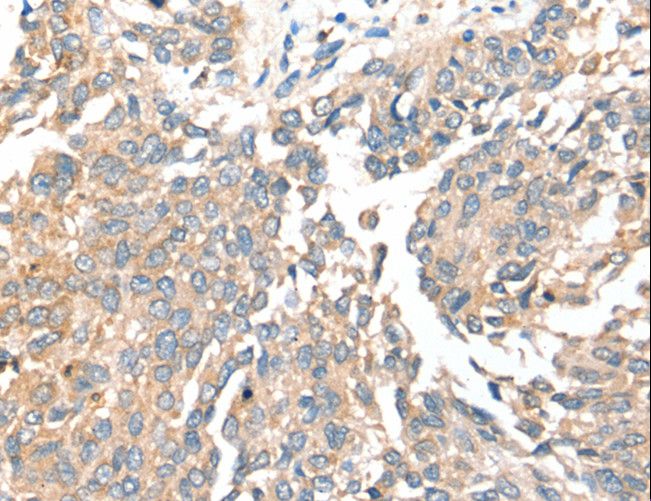 SIRT4 / Sirtuin 4 Antibody - Immunohistochemistry of paraffin-embedded Human lung cancer using SIRT4 Polyclonal Antibody at dilution of 1:35.