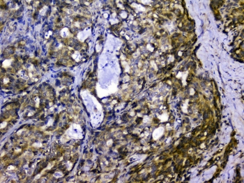 SIRT4 / Sirtuin 4 Antibody - IHC staining of FFPE human stomach cancer with SIRT4 antibody at 1ug/ml. HIER: boil tissue sections in pH6, 10mM citrate buffer, for 10-20 min and allow to cool before testing.