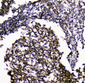 SIRT4 / Sirtuin 4 Antibody - IHC staining of FFPE human glioma with SIRT4 antibody at 1ug/ml. HIER: boil tissue sections in pH6, 10mM citrate buffer, for 10-20 min and allow to cool before testing.