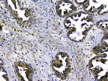 SIRT4 / Sirtuin 4 Antibody - IHC staining of FFPE human ovarian cancer with SIRT4 antibody at 1ug/ml. HIER: boil tissue sections in pH6, 10mM citrate buffer, for 10-20 min and allow to cool before testing.